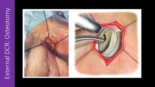 ExternalDCR:Osteotomy
 