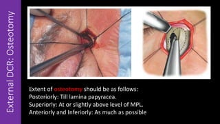 ExternalDCR:Osteotomy
Extent of osteotomy should be as follows:
Posteriorly: Till lamina papyracea.
Superiorly: At or slightly above level of MPL.
Anteriorly and Inferiorly: As much as possible
 