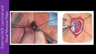ExternalDCR:Lacrimaland
NasalMucosaFlaps
 