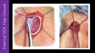 ExternalDCR:FlapClosure
 