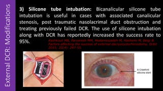 ExternalDCR:Modifications 3) Silicone tube intubation: Bicanalicular silicone tube
intubation is useful in cases with associated canalicular
stenosis, post traumatic nasolacrimal duct obstruction and
treating previously failed DCR. The use of silicone intubation
along with DCR has reportedly increased the success rate to
95%. Kashkouli MB, Parvaresh MM, Modarreszadeh M, Hashemi M, Beigi B.
Factors affecting the success of external dacryocystorhinostomy. Orbit
2015; 22(4): 247-55.
 