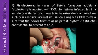 ExternalDCR:Modifications 4) Fistulectomy: In cases of fistula formation additional
fistulectomy is required with DCR. Sometimes infected lacrimal
sac along with necrotic tissue is to be extensively removed and
such cases require lacrimal intubation along with DCR to make
sure that the newer tract remains patent. Systemic antibiotics
are essential to prevent relapse.
 
