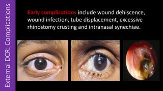 ExternalDCR:Complications
Early complications include wound dehiscence,
wound infection, tube displacement, excessive
rhinostomy crusting and intranasal synechiae.
 