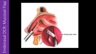 EndonasalDCR:MucosalFlap
 