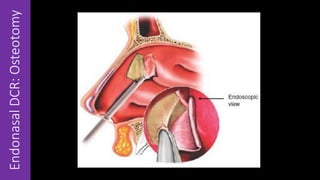 EndonasalDCR:Osteotomy
 