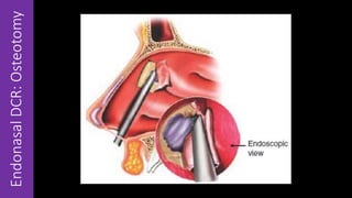 EndonasalDCR:Osteotomy
 