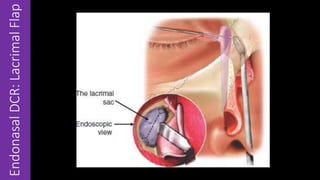 EndonasalDCR:LacrimalFlap
 