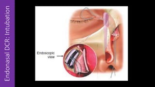 EndonasalDCR:Intubation
 