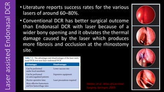 LaserassistedEndonasalDCR • Literature reports success rates for the various
lasers of around 60–80%.
• Conventional DCR has better surgical outcome
than Endonasal DCR with laser because of a
wider bony opening and it obviates the thermal
damage caused by the laser which produces
more fibrosis and occlusion at the rhinostomy
site.
Weber, et al. Atlas of Lacrimal
Surgery, Springer, 2009.
 