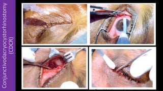 Conjunctivodacryocystorhinostomy
(CDCR)
 
