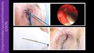 Conjunctivodacryocystorhinostomy
(CDCR)
 