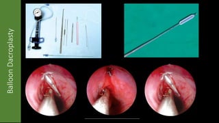 BalloonDacroplasty
 