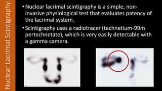 CTScan •CT is required in the following situations:
1. Following trauma
2. To evaluate a patient with a suspected lacrimal...