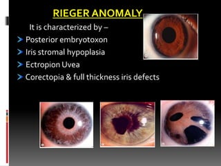 Defect In The Iris ANATOMY OF IRIS AND ITS CONGENITAL ANOMALIES | PPTX