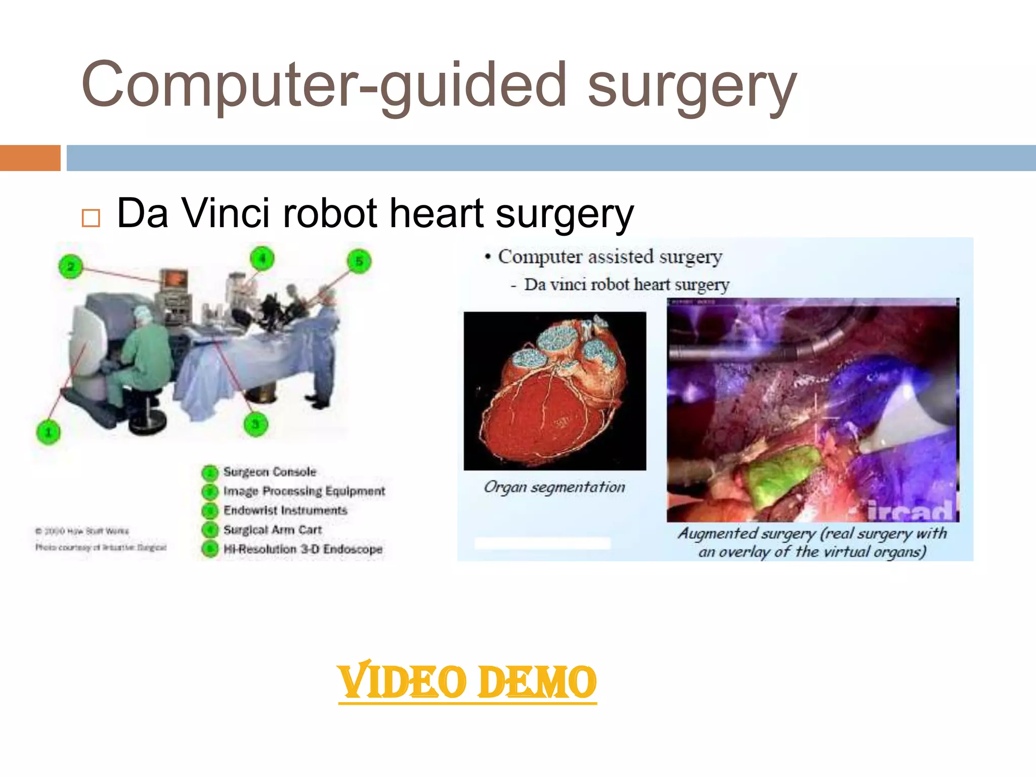 Computer-guided surgery
 Da Vinci robot heart surgery
VIDEO DEMO
 