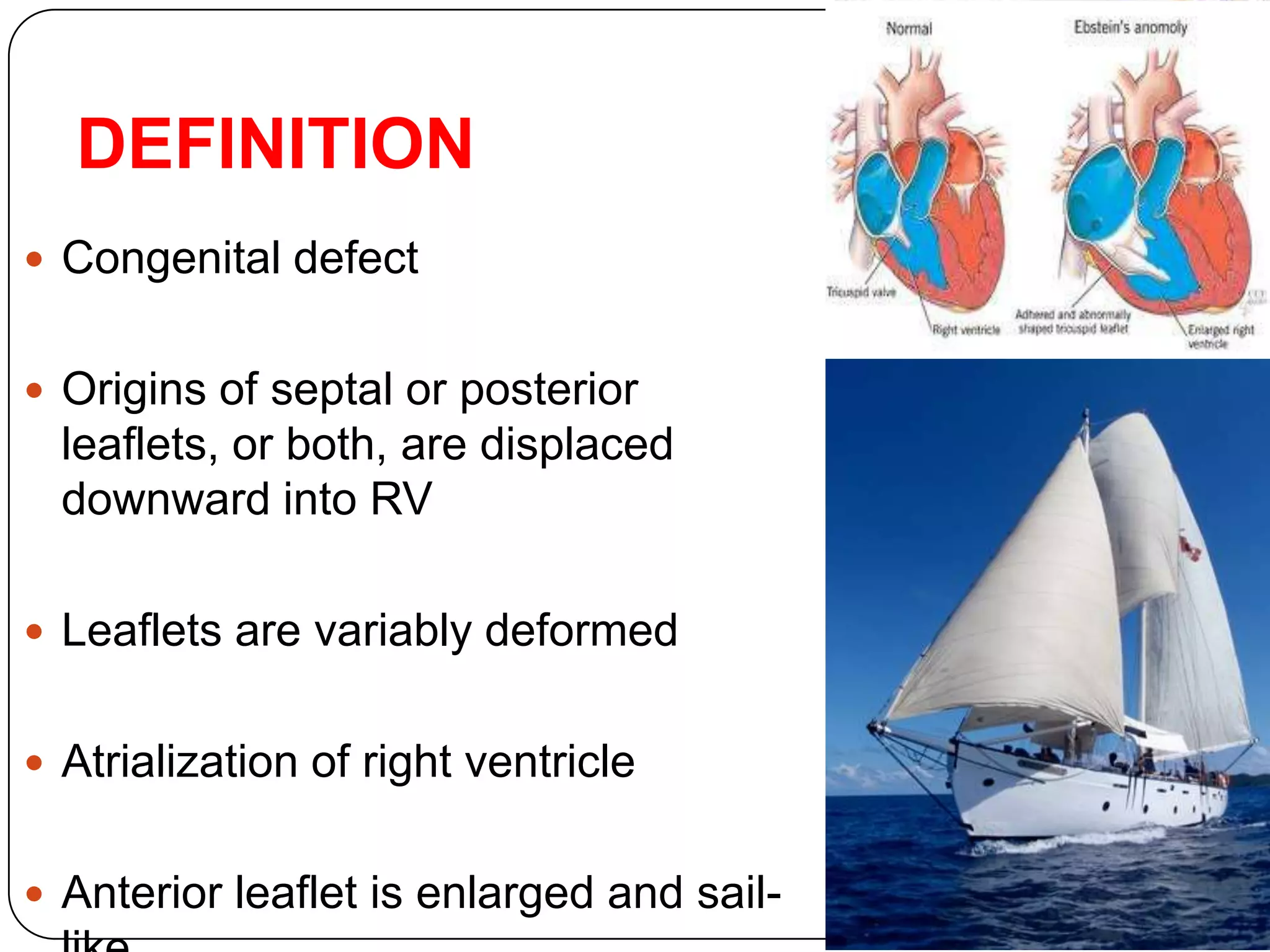 DEFINITION
 Congenital defect
 Origins of septal or posterior
leaflets, or both, are displaced
downward into RV
 Leaflets are variably deformed
 Atrialization of right ventricle
 Anterior leaflet is enlarged and sail-
 