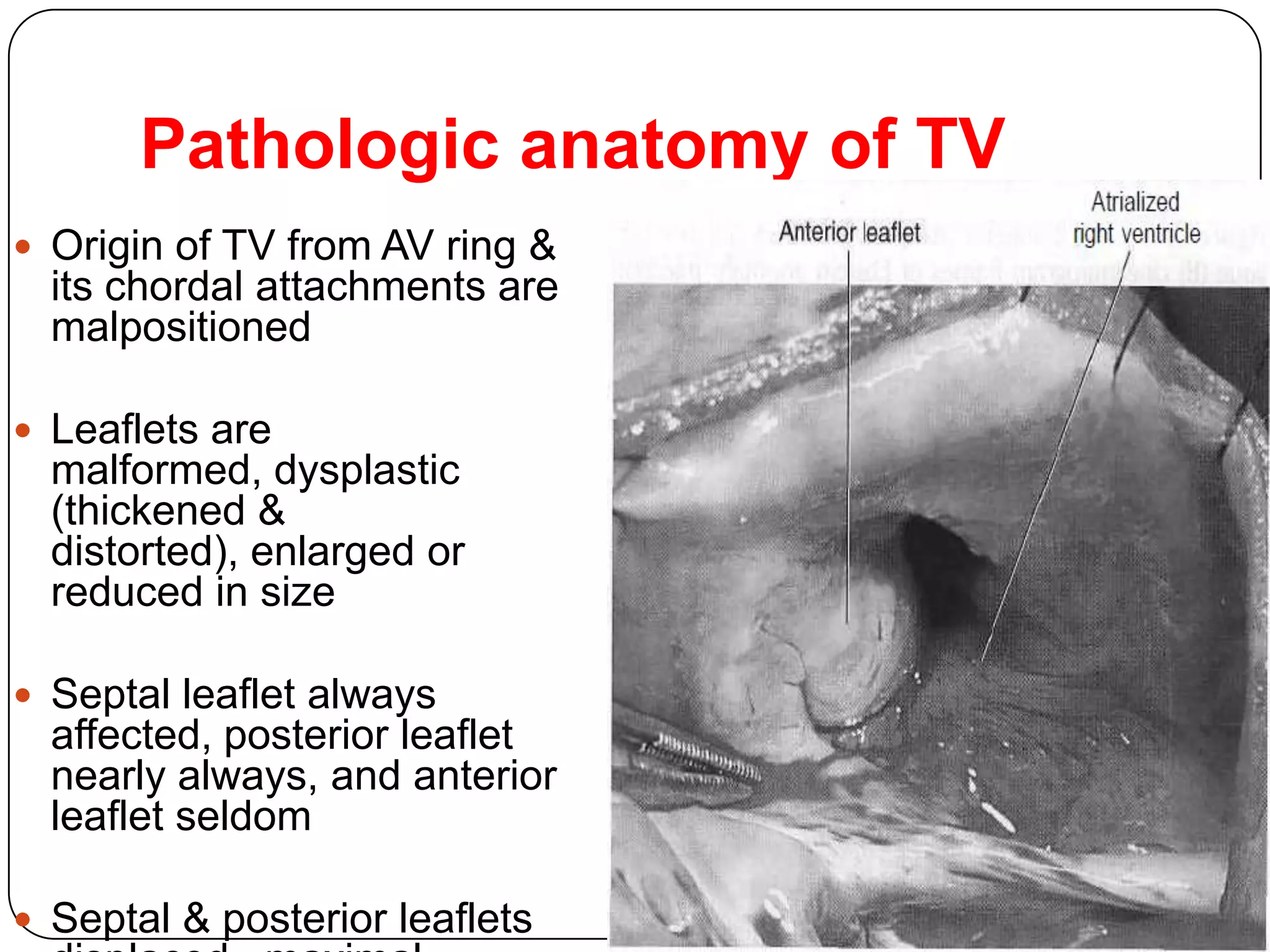Pathologic anatomy of TV
 Origin of TV from AV ring &
its chordal attachments are
malpositioned
 Leaflets are
malformed, dysplastic
(thickened &
distorted), enlarged or
reduced in size
 Septal leaflet always
affected, posterior leaflet
nearly always, and anterior
leaflet seldom
 Septal & posterior leaflets
 