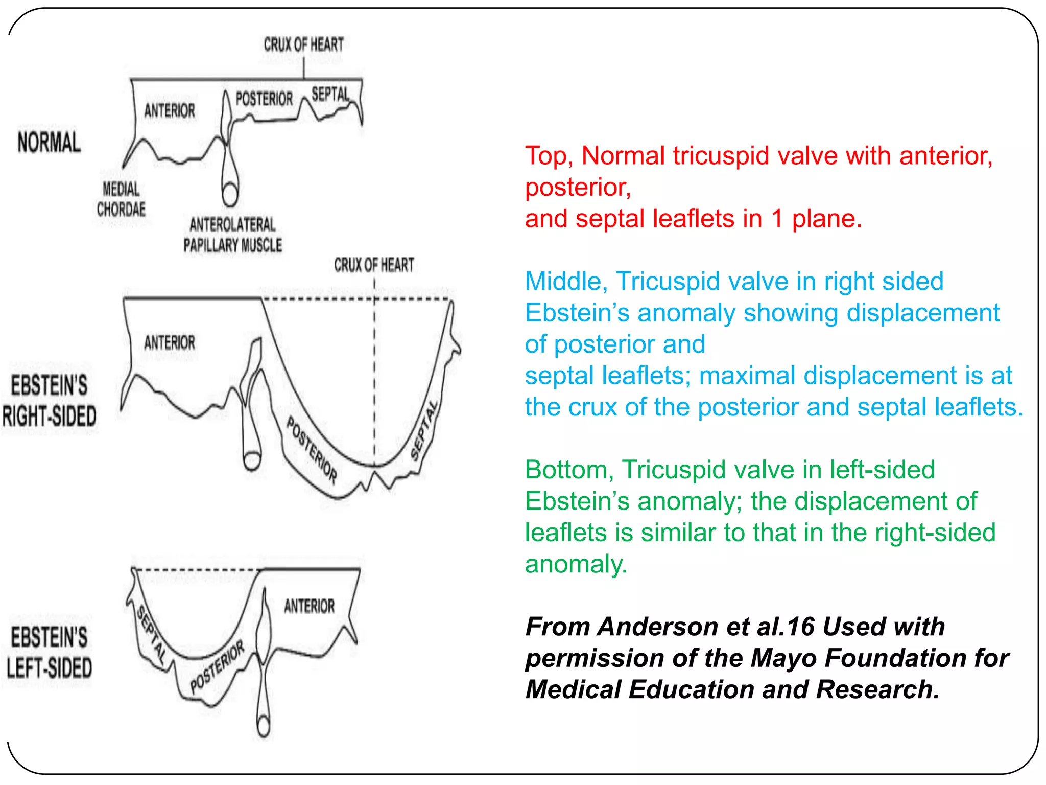Top, Normal tricuspid valve with anterior,
posterior,
and septal leaflets in 1 plane.
Middle, Tricuspid valve in right sided
Ebstein’s anomaly showing displacement
of posterior and
septal leaflets; maximal displacement is at
the crux of the posterior and septal leaflets.
Bottom, Tricuspid valve in left-sided
Ebstein’s anomaly; the displacement of
leaflets is similar to that in the right-sided
anomaly.
From Anderson et al.16 Used with
permission of the Mayo Foundation for
Medical Education and Research.
 