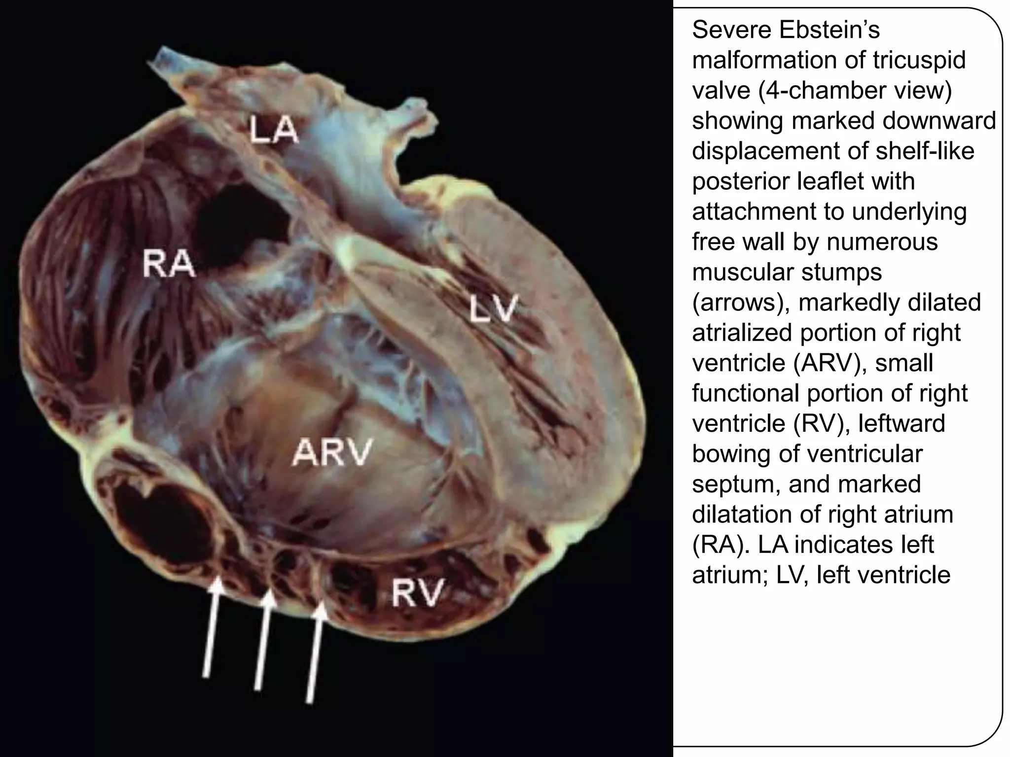 Severe Ebstein’s
malformation of tricuspid
valve (4-chamber view)
showing marked downward
displacement of shelf-like
posterior leaflet with
attachment to underlying
free wall by numerous
muscular stumps
(arrows), markedly dilated
atrialized portion of right
ventricle (ARV), small
functional portion of right
ventricle (RV), leftward
bowing of ventricular
septum, and marked
dilatation of right atrium
(RA). LA indicates left
atrium; LV, left ventricle
 