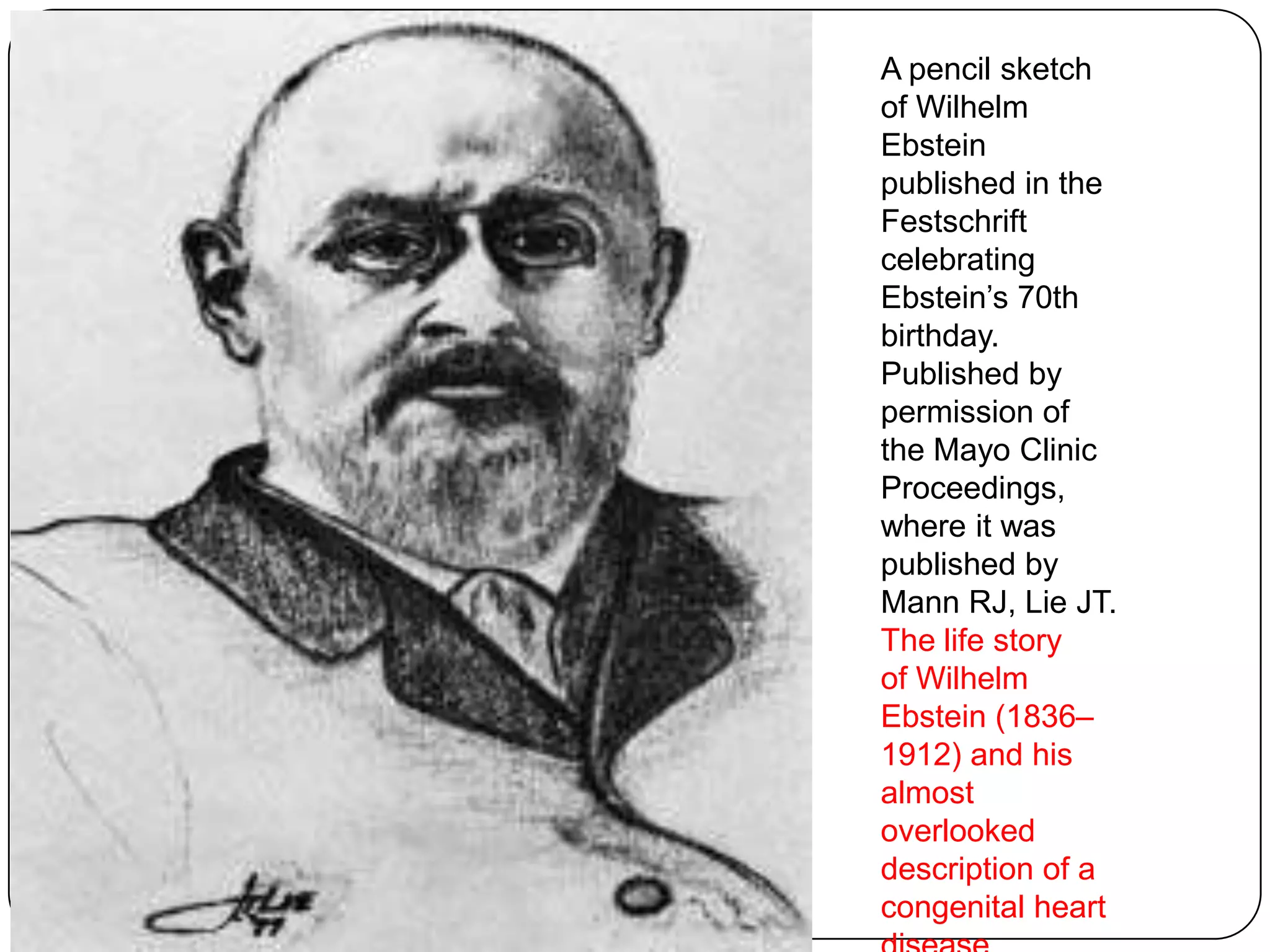 A pencil sketch
of Wilhelm
Ebstein
published in the
Festschrift
celebrating
Ebstein’s 70th
birthday.
Published by
permission of
the Mayo Clinic
Proceedings,
where it was
published by
Mann RJ, Lie JT.
The life story
of Wilhelm
Ebstein (1836–
1912) and his
almost
overlooked
description of a
congenital heart
 
