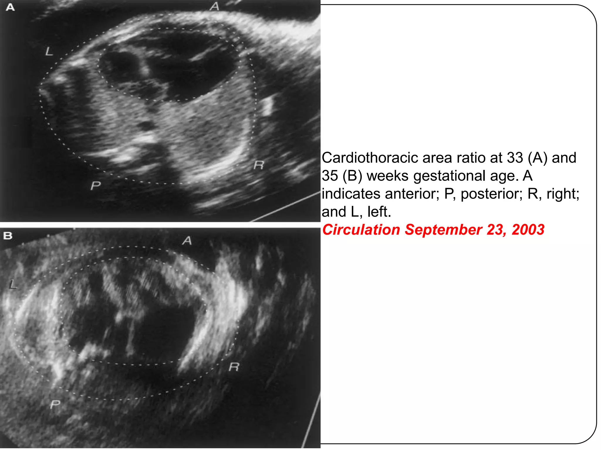 Cardiothoracic area ratio at 33 (A) and
35 (B) weeks gestational age. A
indicates anterior; P, posterior; R, right;
and L, left.
Circulation September 23, 2003
 