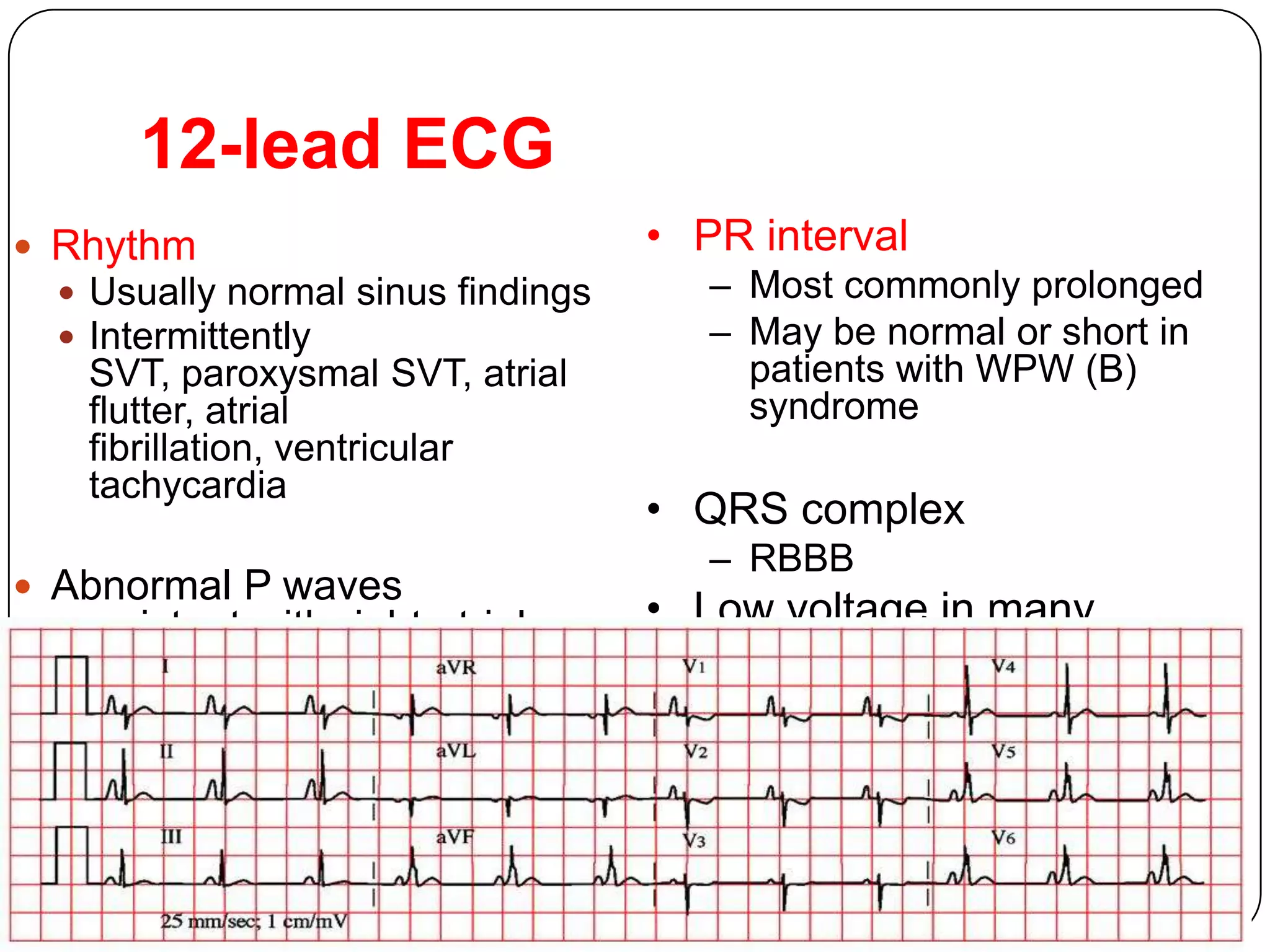 12-lead ECG
 Rhythm
 Usually normal sinus findings
 Intermittently
SVT, paroxysmal SVT, atrial
flutter, atrial
fibrillation, ventricular
tachycardia
 Abnormal P waves
consistent with right atrial
enlargement – “Himalayan
P waves”
• PR interval
– Most commonly prolonged
– May be normal or short in
patients with WPW (B)
syndrome
• QRS complex
– RBBB
• Low voltage in many
patients
 