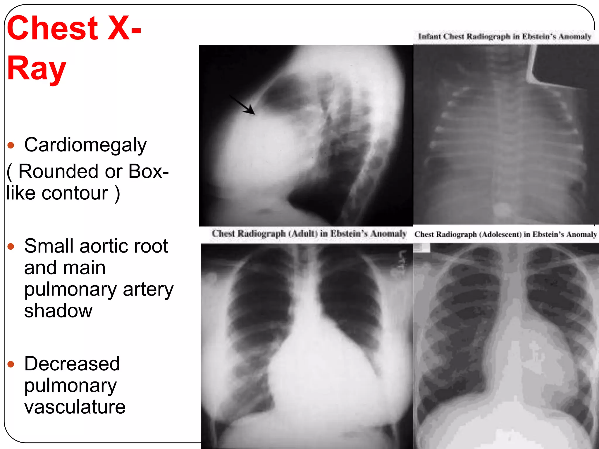 Chest X-
Ray
 Cardiomegaly
( Rounded or Box-
like contour )
 Small aortic root
and main
pulmonary artery
shadow
 Decreased
pulmonary
vasculature
 