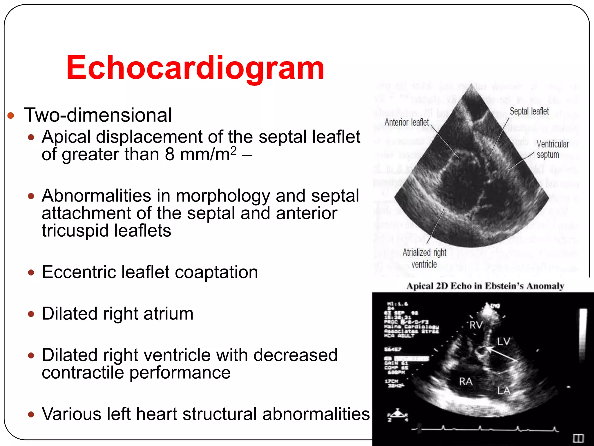 Echocardiogram
 Two-dimensional
 Apical displacement of the septal leaflet
of greater than 8 mm/m2 –
 Abnormalities in morphology and septal
attachment of the septal and anterior
tricuspid leaflets
 Eccentric leaflet coaptation
 Dilated right atrium
 Dilated right ventricle with decreased
contractile performance
 Various left heart structural abnormalities
 