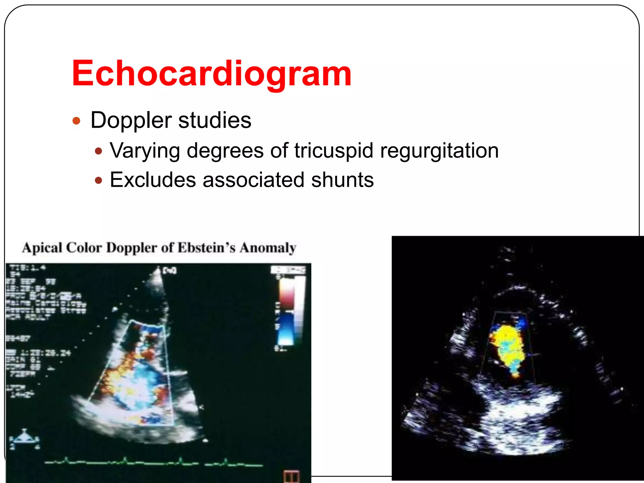 Echocardiogram
 Doppler studies
 Varying degrees of tricuspid regurgitation
 Excludes associated shunts
 