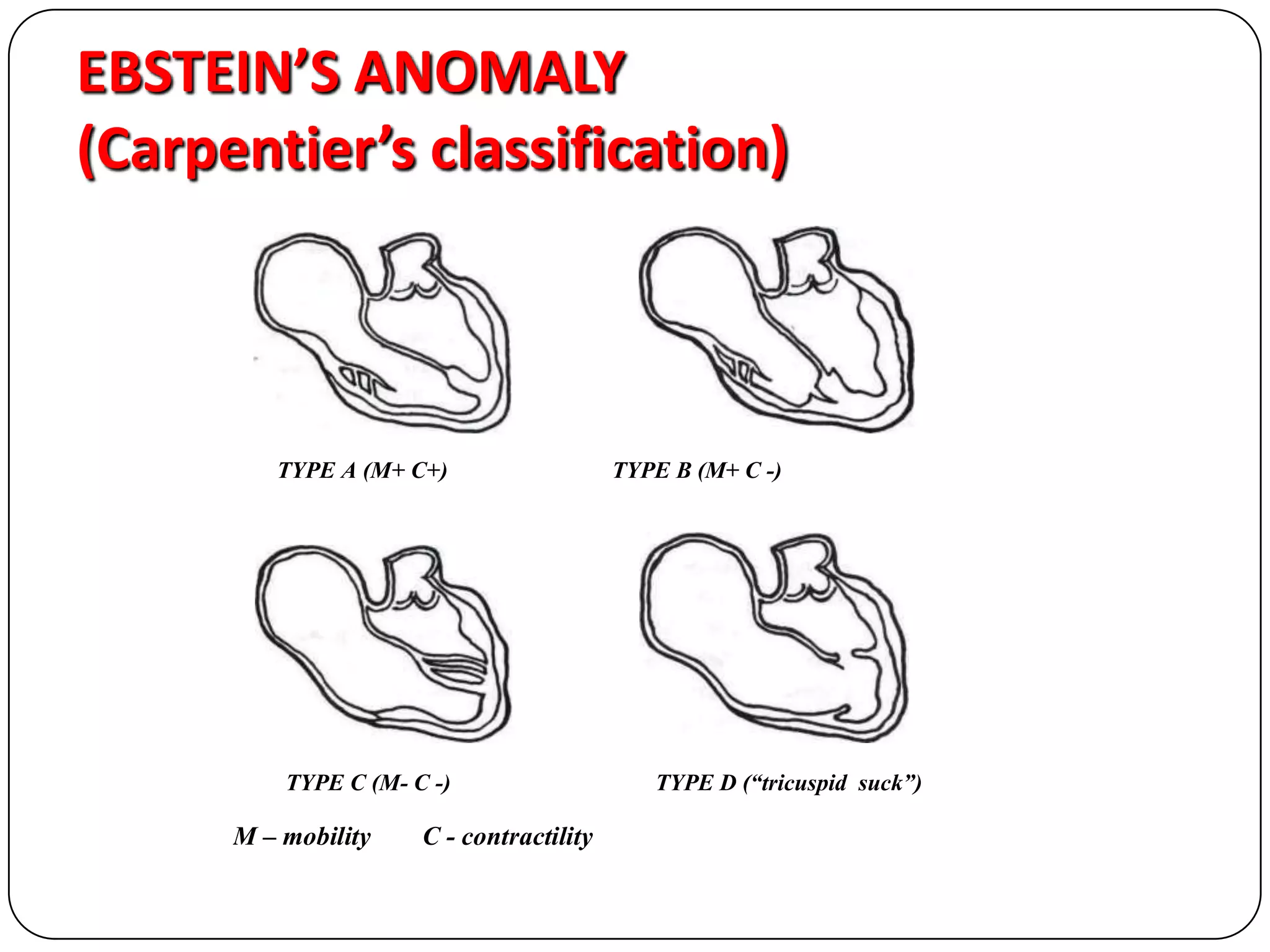 EBSTEIN’S ANOMALY
(Carpentier’s classification)
TYPE A (M+ C+) TYPE B (M+ C -)
TYPE С (M- C -) TYPE D (“tricuspid suck”)
M – mobility C - contractility
 