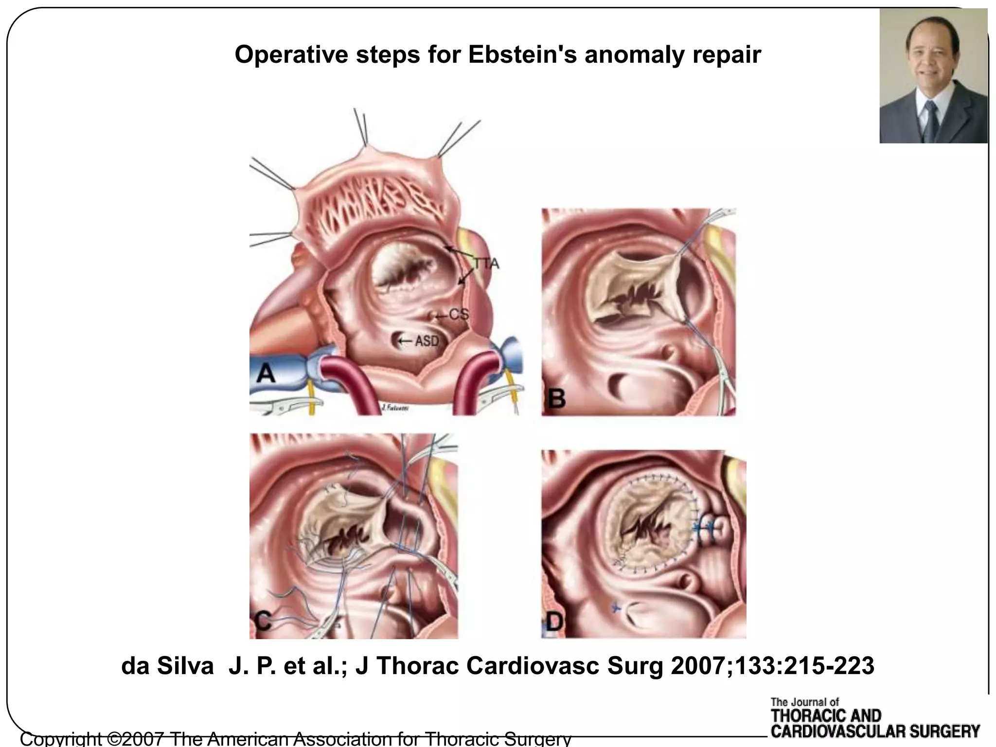 Copyright ©2007 The American Association for Thoracic Surgery
da Silva J. P. et al.; J Thorac Cardiovasc Surg 2007;133:215-223
Operative steps for Ebstein's anomaly repair
 