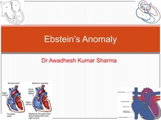 Dr Awadhesh Kumar Sharma
Ebstein’s Anomaly
 