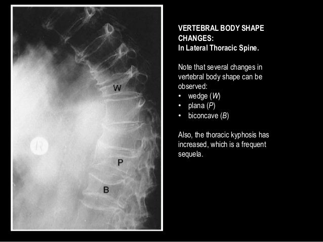 metabolic bone disorders