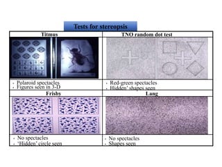 Tests for stereopsis
Titmus
• Red-green spectacles
TNO random dot test
• Hidden’ shapes seen
• Polaroid spectacles
• Figures seen in 3-D
Lang
• No spectacles
Frisby
• ‘Hidden’ circle seen
• No spectacles
• Shapes seen
 