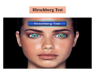 Hirschberg Test
 