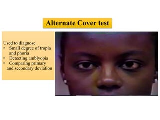 Alternate Cover test
Used to diagnose
• Small degree of tropia
and phoria
• Detecting amblyopia
• Comparing primary
and secondary deviation
 