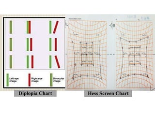 Diplopia Chart Hess Screen Chart
 