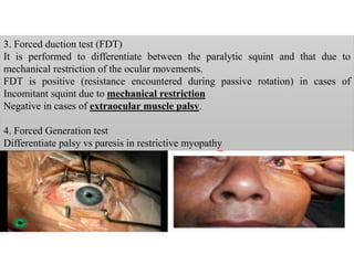 3. Forced duction test (FDT)
It is performed to differentiate between the paralytic squint and that due to
mechanical restriction of the ocular movements.
FDT is positive (resistance encountered during passive rotation) in cases of
Incomitant squint due to mechanical restriction
Negative in cases of extraocular muscle palsy.
4. Forced Generation test
Differentiate palsy vs paresis in restrictive myopathy
 