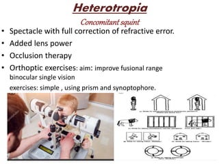 Heterotropia
Concomitant squint
• Spectacle with full correction of refractive error.
• Added lens power
• Occlusion therapy
• Orthoptic exercises: aim: improve fusional range
binocular single vision
exercises: simple , using prism and synoptophore.
 