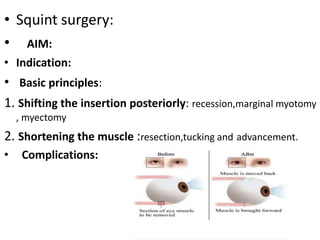 • Squint surgery:
• AIM:
• Indication:
• Basic principles:
1. Shifting the insertion posteriorly: recession,marginal myotomy
, myectomy
2. Shortening the muscle :resection,tucking and advancement.
• Complications:
 