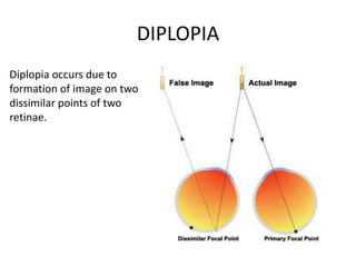 DIPLOPIA
Diplopia occurs due to
formation of image on two
dissimilar points of two
retinae.
 