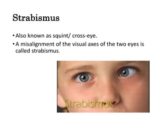 Strabismus
•Also known as squint/ cross-eye.
•A misalignment of the visual axes of the two eyes is
called strabismus.
 