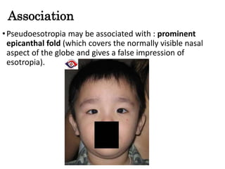 Association
•Pseudoesotropia may be associated with : prominent
epicanthal fold (which covers the normally visible nasal
aspect of the globe and gives a false impression of
esotropia).
 