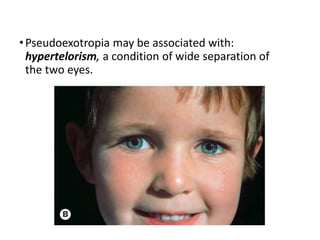 •Pseudoexotropia may be associated with:
hypertelorism, a condition of wide separation of
the two eyes.
 