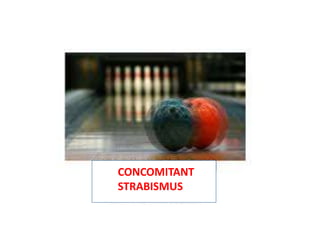 CCCC
CONCOMITANT
STRABISMUS
 