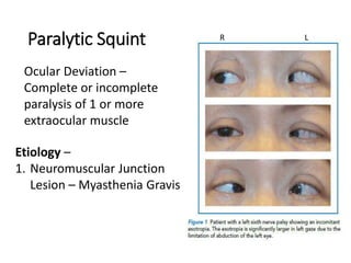 Paralytic Squint
Ocular Deviation –
Complete or incomplete
paralysis of 1 or more
extraocular muscle
Etiology –
1. Neuromuscular Junction
Lesion – Myasthenia Gravis
R L
 