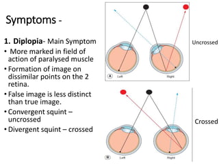Symptoms -
1. Diplopia- Main Symptom
• More marked in field of
action of paralysed muscle
• Formation of image on
dissimilar points on the 2
retina.
• False image is less distinct
than true image.
• Convergent squint –
uncrossed
• Divergent squint – crossed
Uncrossed
Crossed
 