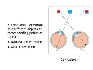 2. Confusion- Formation
of 2 different objects on
corresponding points of
retina
3. Nausea and vomiting
4. Ocular deviation
Confusion
 
