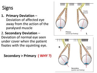 Signs
1. Primary Deviation –
Deviation of affected eye
away from the action of the
paralysed muscle
2. Secondary Deviation –
Deviation of normal eye seen
under cover when the patient
fixates with the squinting eye.
Secondary > Primary ( WHY ?)
L
R
 