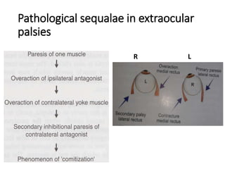 Pathological sequalae in extraocular
palsies
LR
 